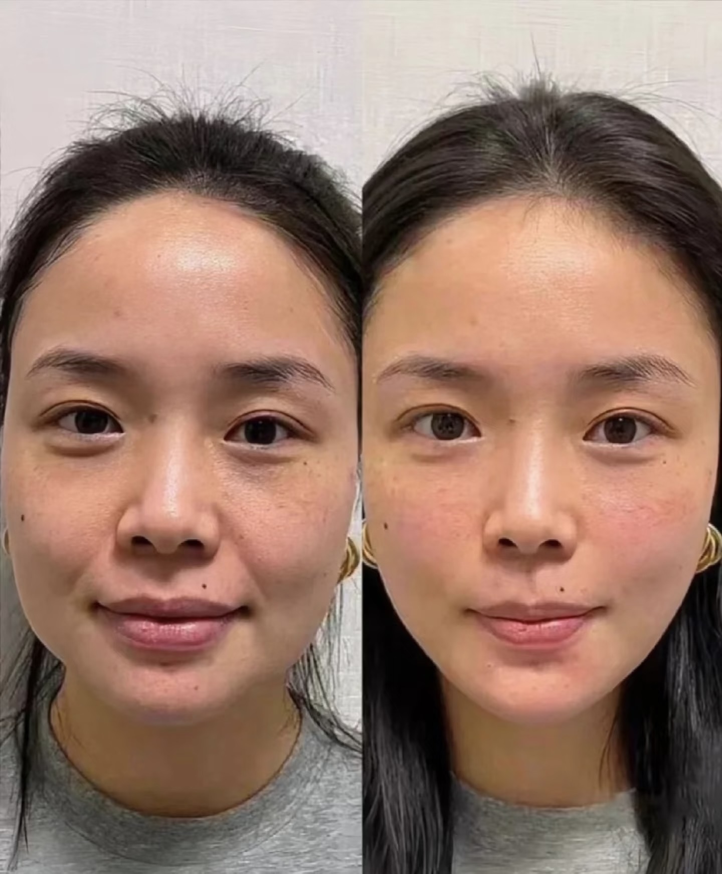Kết quả cấy HA