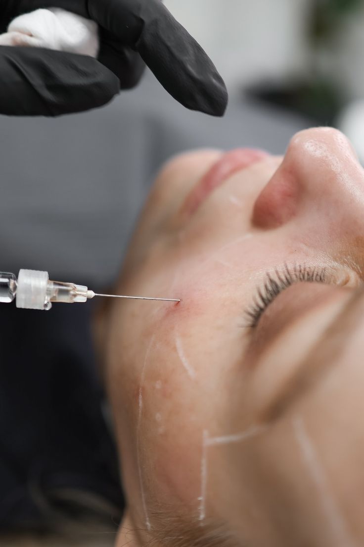 Cấy HA Làm Đầy Tú An Clinic