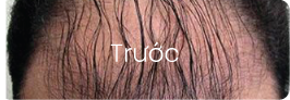 Trước trị liệu