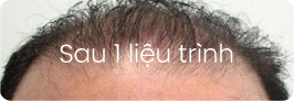 Sau 1 liệu trình