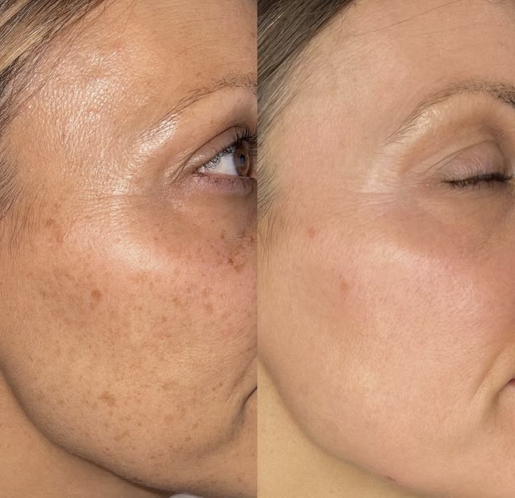 Laser Điều trị nám & tăng sắc tố