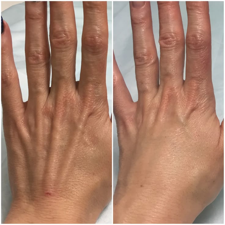 Meso Hand trước