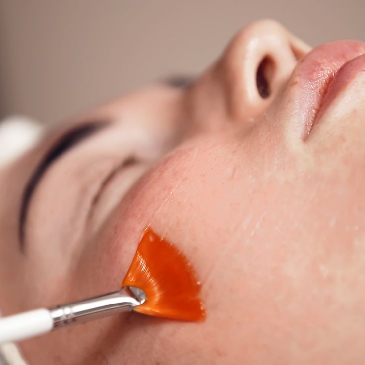 Peel Acne Clinic