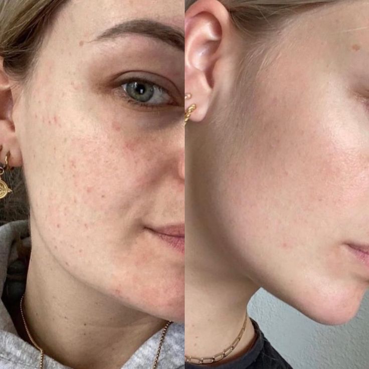 Peel Renews Dermatic
