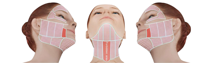 Vùng trị liệu HIFU Ultherapy Plus